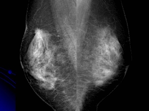 イメージ｜左の乳房に乳がんが写っているマンモグラフィーの一例
