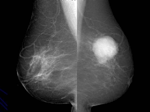 要 乳がん 精密 検査 検診 乳がん検診で石灰化や経過観察・ 要精密検査だった方｜HAKU